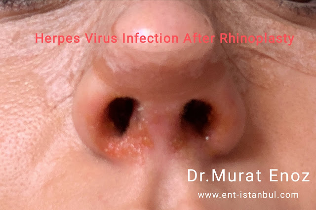 Nasal Herpes,HSV,herpes simplex virus infection before the rhinoplasty,