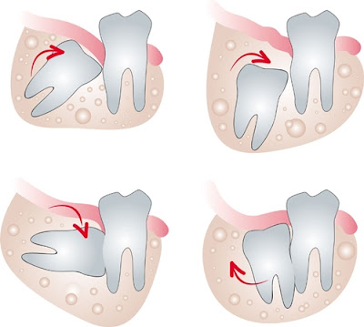 Chữa đau răng khôn từ tự nhiên