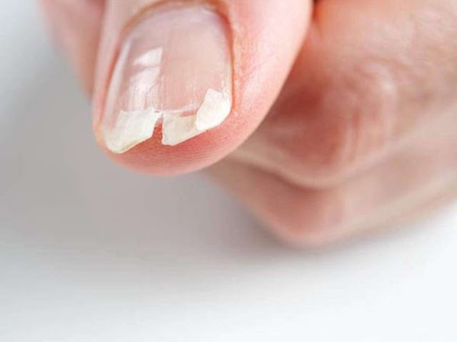Remèdes naturelles des ongles cassants et fragiles