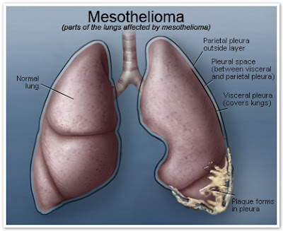 What Is Mesothelioma?