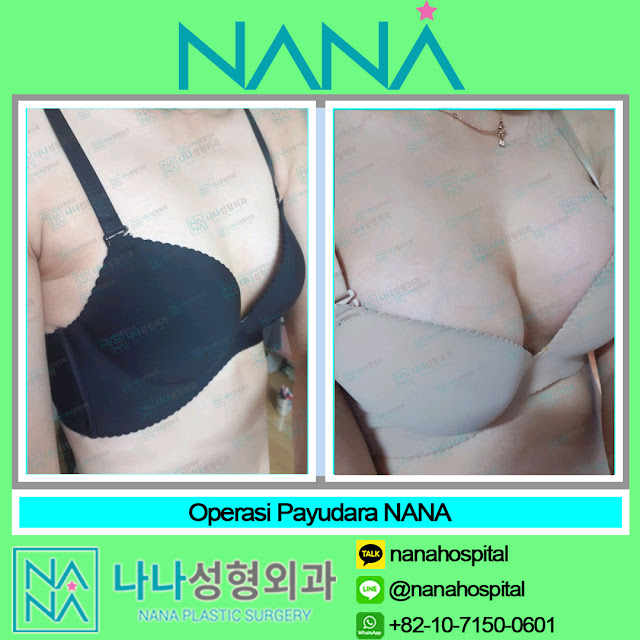 dada, dada besar, dokter korea, hasil alami, hwangdongyeon, operasi dada, operasi korea, operasi payudara, operasi plastik, operasi plastik korea, oplas, oplas korea, payudara, payudara indah, v-line