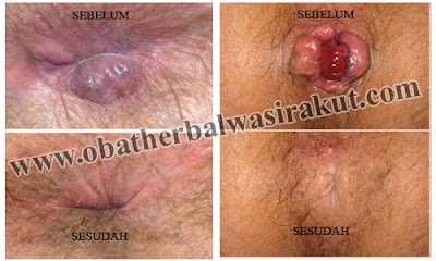 gejala ambeien, gejala wasir, obat alami ambeien, obat ambeien, obat ambeien alami, obat ambeien tanpa operasi, obat herbal ambeien, obat herbal wasir, obat wasir, obat wasir alami, 