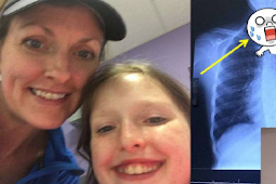 Anak 10 Tahun Ini Tak Sengaja Menelan "Roda Spinner" Saat Sedang Asik Main, Ibunya Hampir Pingsan Ketika Melihat "Hasil X-Ray" yang Mengerikan Ini! 