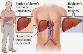  Treatments of cancer liver