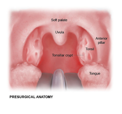 Tonsillectomy steps