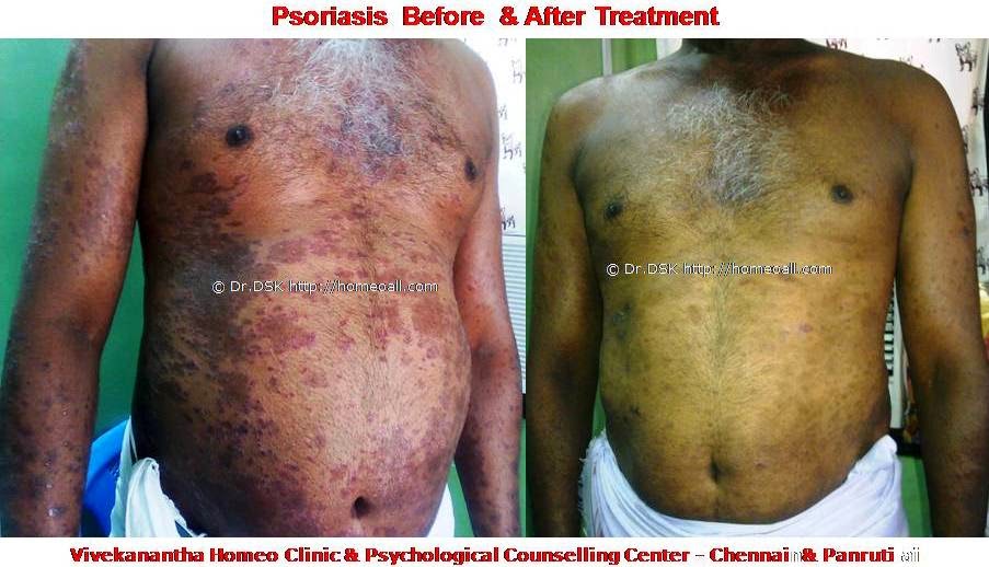 Psoriasis - சொரியாசிஸ்  சொரியாசிஸ்  - Psoriasis  என்றால் என்ன ? சொரியாசிஸ் என்பது தோல் அழற்சி நிலையாகும். இதை மீன் செதில் படை என்றும் அழைக்கலாம்.   சொரியாசிஸ் தோலில் உள்ள செல்கள் வேகமாக இறப்பதன் மூலம் உண்டாகிறது.  இதன் விளைவாக தோல் தடித்து மீன் செதில் போன்று இறந்த செல்கள் உதிரும், புரையோடும். தோலிலுள்ள பல சிறு இரத்த நாளங்கள்  வீங்கிவிடுவதால்  தோல் சிவப்பு நிறமாகக் காணப்படும்.  சொரியாசிஸ் எவ்வாறு தோற்றமளிக்கும்? • சொரியாசிஸ் என்பது தோலில், மீன் செதில் போன்று இறந்த செல்கள் உதிர்ந்து விழும் புரையுடன் கூடிய வெண்மை / சிவப்பு திட்டுகளாக (Silver Scaly patches) காணப்படும். • உடலின் எந்தப்பாகத்தில் வேண்டுமானாலும் வரலாம். • முழங்கை, முழுங்கால் மூட்டு, முதுகு, தலையுச்சி முதலிய பாகங்கள் பொதுவாக பாதிக்கப்படும்.  சொரியாசிஸ் தொற்று நோயா? • சொரியாசிஸ் தொற்று நோயல்ல. இது மற்றவர்களுக்கு பரவாது • சுகாதார குறைவு காரணமாக இது ஏற்படாது.  சொரியாசிஸ் வர காரணம் என்ன ? • சொரியாசிஸ் மரபு காரணம் மற்றும் சுற்றுச் சூழல் நிலை இவற்றின் பாதிப்பினால் ஏற்படுகிறது என்று நம்பப்படுகிறது. • சொரியாசிஸால் பாதிக்கப்படுபவர்களில் 25% பேர் சொரியாசிஸ் நோயுடைய குடும்பத்திலிருந்து வந்தவர்களே, சிலருக்கு மரபு நிலை காரணமாகிறது. • உடல், மன அழுத்தங்கள், குரல்வளை தொற்று, ப்ளூ, ஸ்டீராய்ட் ஹார்மோன்ஸ், சில ஆண்ட்டி ஹைபர் டென்சிவ்  போன்ற சில மருந்துகள், சோரியாசிஸை மேலும் மோசமாக்கும். • குடிபழக்கம், புகைபிடித்தல் சொரியாசிஸை மோசமாக்கும்.  சொரியாசிஸ் நோயின் விளைவுகள் • சொரியாசிஸ் நோயாளிகளுக்கு மூட்டுவலிகளும், வீக்கமும் வரலாம். • சொரியாசிஸ் விரல்களையும், கால்விரல் நகங்களையும் தாக்கி, சிறு குழிகளையும், கருமை நிறத்தையும், நகங்கள் தடிப்பையும், ஏற்படுத்தும். நகம் உடையலாம்.  சொரியாசிஸ் யாருக்கு வரும் ? • சொரியாசிஸ் ஆண், பெண் இருவரையும் சமமாகத் தாக்கலாம். • சொரியாசிஸ் எந்த வயதில் வேண்டுமானாலும் வரலாம். வழக்கமாக 20 வது வயதில் தாக்கத் தொடங்கும். பிறப்பிலிருந்தும் முதிய வயதிலும் கூட இது வரலாம். • ஒரு முறை சொரியாசிஸ் வந்ததும், குறைதல், தணிதல், அதிகரித்தல் என பல்வேறு நிலை மாற்றங்கள் ஏற்படும்.  சொரியாசிஸ்க்கு என்ன மருத்துவங்கள் உள்ளன. நவீன மருத்துவத்தில் பல மருந்துகள் உபயோகப்படுத்தப்படுகின்றன, டாபிகல் ஸ்டீராய்ட்ஸ்  மேற்பூச்சுக்கள் (Steroids creams), போட்டோதெரபி, அல்ட்ரா வைலட்,  மெதாட்டுரக்ஸாட் (methotrexate) இத்தகைய மருந்துகள் பக்க விளைவுகளை ஏற்படுத்தும். எனவே நோயாளிகள் இந்தப் பக்க விளைவுகளைப் பரிசோதித்துக் கொள்ள அடிக்கடி இரத்த பரிசோதனை செய்து கொள்ள வேண்டும். மேலும் தொடர்ந்து இந்த மருந்துகளை உட்கொள்ளக்கூடாது.   சொரியாசிஸ் நோயாளிகள் செய்யக்கூடாதவை, செய்ய வேண்டியவை  தோலைச் சொரியாதீர்கள் ஏனெனில் இது குணமாவதைத் தாமதப்படுத்தும்.  ஹோமியோபதி மருந்துகள் வேலை செய்து விளைவுகள் காட்ட பல வாரங்கள் ஆகுமாதலால் மருத்துவத்தை விரைவில், இடையில் நிறுத்திவிடாதீர்கள்.  சொரியாசிஸைக் கட்டுப்படுத்த  தரப்பட்ட மருந்துகளையும், மருத்துவத்தையும் திடீரென்று நிறுத்திவிடாதீர்கள். இதனால் நோய் இன்னும் மோசமாகும்.  மருந்துகளை தொடர்ந்து சீராக எடுத்துக்கொள்ளுங்கள்.  தோலை எப்போதும் ஈரத்தன்மையுடையதாக வைத்திருங்கள். அது நமைச்சலையும், அரிப்பையும், புரை ஏற்படுவதையும் தடுக்கும்.  சூரிய ஒளியில் இருப்பது பொதுவாக நல்லதே, ஆனால் அதிகமாக வெகு நேரம் இருப்பதால் வேர்க்குருக்கள் உண்டாகும். அதனால் சொரியாசிஸ் தீவிரமடையும்.  மன அழுத்தம் சொரியாசிஸை அதிகப்படுத்தும். அமைதியாக இருக்கவும், உடற்பயிற்சி செய்யவும், ஒய்வு எடுத்துக்கொள்ளவும்,    சோரியாஸிஸ் ஹோமியோபதி மருத்துவ சிகிச்சை, நோயின் அறிகுறிகளுக்கேற்ற ஹோமியோபதி மருத்துவசிகிச்சை நோயின் தன்மையை நன்கு கட்டுப்படுத்தி விரைவில் நல்ல பலனளிக்கும். தொடர்ந்து ஹோமியோபதி மருந்துகளை உட்கொள்வதன் மூலம் நல்ல பலன்பெறலாம்.       ஹோமியோபதி சிகிச்சைக்கு தொடர்பு கொள்ளவும் ஹோமியோபதி சிறப்பு மருத்துவர் செந்தில் குமார் தண்டபாணி அவர்களிடம் இதைப்போன்ற  நோய்களுக்கு சிகிச்சை பெற்று பலர் நல்ல பலனடைந்திருக்கிறார்கள். மருத்துவர் செந்தில் குமார் அவர்களை சென்னை, வேளச்சேரி விவேகானந்தா ஹோமியோபதி கிளினிக் & உளவியல் ஆலோசனை மையத்தில் சந்திக்கலாம். முன்பதிவு அவசியம். முன்பதிவிற்கு தொடர்புகொள்ளவும் 9786901830, மின் அஞ்சல்: consult.ur.dr@gmail.com       மேலும் விபரங்களுக்கும் ஆலோசனைக்கும் சிகிச்சைக்கும் தொடர்பு கொள்க விவேகானந்தா கிளினிக் ஆலோசனை மையங்கள் & தொடர்பு எண்கள் சென்னை:- 9786901830  பண்ருட்டி:- 9443054168  புதுச்சேரி:- 9865212055 (Camp) மின் அஞ்சல் : consult.ur.dr@gmail.com, homoeokumar@gmail.com   முன்பதிவிற்கு அழைக்கவும் அல்லது மின் அஞ்சல் அனுப்பவும்.  முன்பதிவிற்கு: உங்களின் பெயர் - வயது – அலைபேசி எண் – பிரச்சனை (ஒரு வரியில்) தேதி – கிழமை – இடம், முதலியவற்றை குறுந்தகவல் மூலம் அனுப்பவும். உதாரணம்: ரம்யா - 28 – 99******00 – சோரியாசிஸ் Psoriasis – 20-12-2014 – சனிக்கிழமை – சென்னை, மருத்துவர் உங்களின் முன்பதிவை குறுந்தகவல் மூலம் உறுதிப்படுத்துவார்.