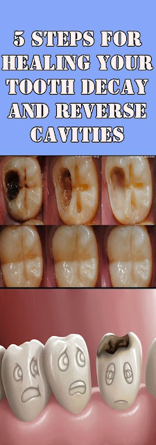 REVERSE CAVITIES AND HEAL TOOTH DECAY WITH THESE 5 STEPS!