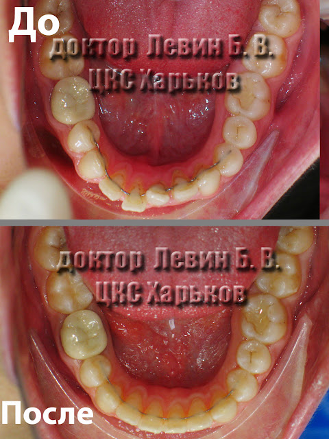 Форма нижнего зубного ряда до и после лечения.
