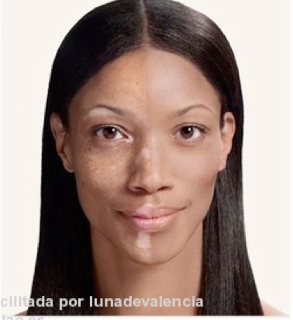 vitiligo