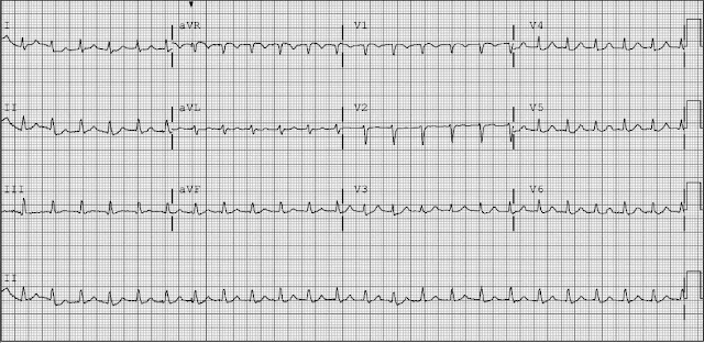 ECG