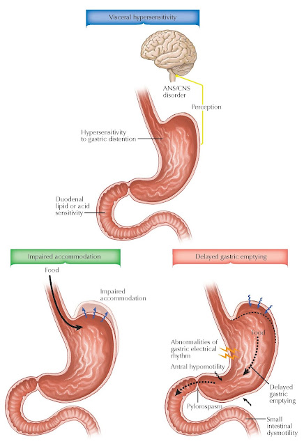 FUNCTIONAL DYSPEPSIA