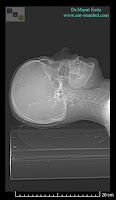 nasal septum deviation - septoplasty operation - imaging