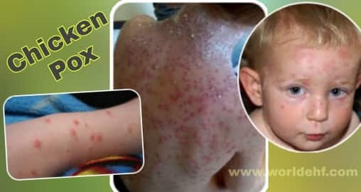 Chiken Pox Treatment in Electro Homeopathy