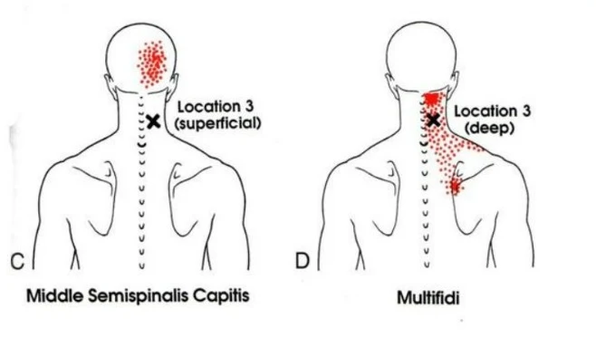dolor cervical y dolor de cabeza - semiespinoso superior de la cabeza - semiespinoso medio de la cabeza - multifídico - mc spa