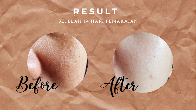 Rekomendasi Skincare untuk Mengecilkan Pori-pori