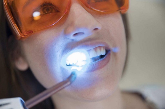 Lasers Used in Teeth Whitening