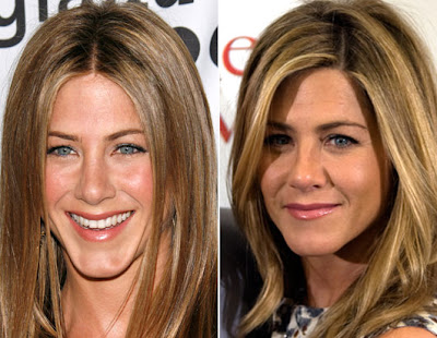 Jennifer Aniston Plastic Surgery Before And After