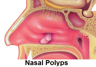 Treatment For Nasal Polyps