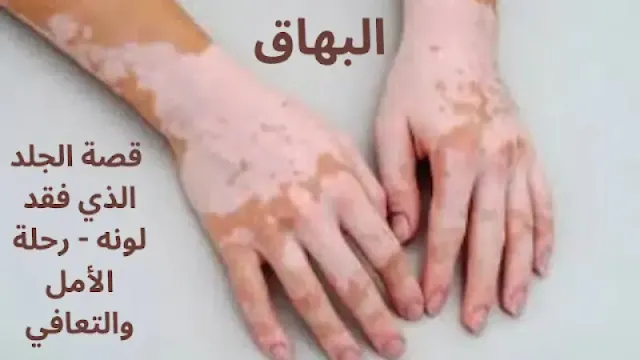 البهاق: قصة الجلد الذي فقد لونه - رحلة الأمل والتعافي