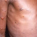 what is monkey pox? what is monkeypox virus? what is monkeypox treatment? what is monkeypox? How deadly is monkeypox? What exactly is monkeypox? What are the monkeypox symptoms?   Monkeypox is a public health emergency. Here's what you need to know about the virus