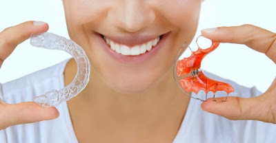 Vì sao cần đeo hàm duy trì sau niềng răng?