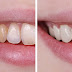  Tẩy trắng răng có an toàn không?