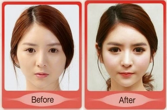 Gadis Korea Operasi Plastik