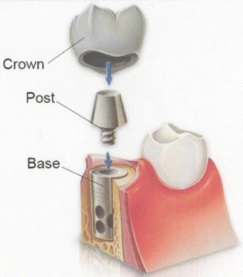 Phục hồi răng đã mất với phương pháp cấy ghép Implant