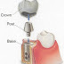 Cấy ghép Implant – Bí quyết phục hồi răng đã mất