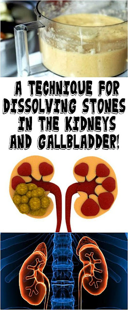 Amazing Natural Remedy To Dissolve Kidney & Gallbladder Stones