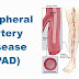 What to Know About Peripheral Vascular Disease