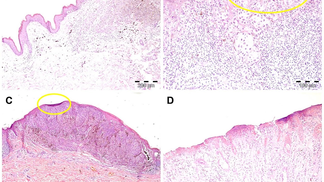 Melanoma - Ulcerated Melanoma Pictures