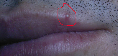 Pimple on lip is not only an