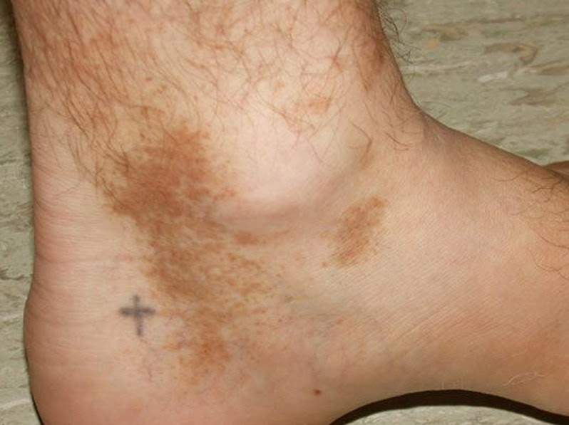 brown spots on ankles - pictures, photos