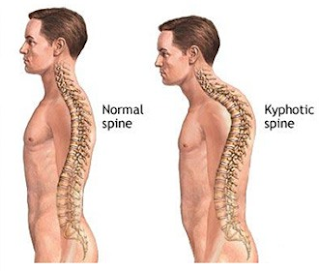 Kifosis ( tulang belakang melengkung ke belakang)