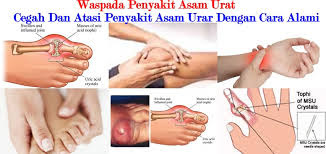 obat asam urat buat ibu menyusui