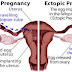 Ectopic pregnancy-A pregnancy occurring outside uterus & its complications