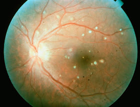  patient presents with blurred vision, floaters, or flashes of light