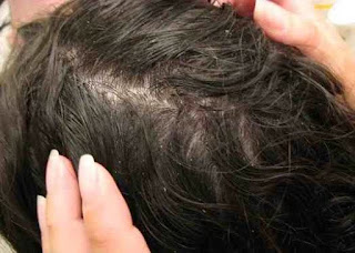 Cara menghilangkan telur kutu rambut dengan cepat