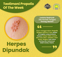 herbal untuk herpes