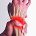 Inflammatory Rheumatoid arthritis - Alternative Cures