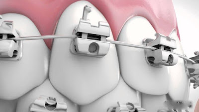 Tìm hiểu về phương pháp niềng răng mắc cài kim loại