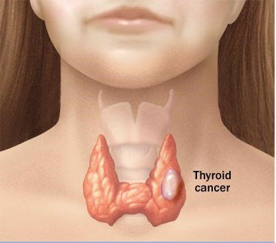 TG dan anti-TG untuk kanser tiroid.