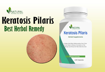 Natural Remedy for Keratosis Pilaris: Cod Liver Oil Treatment