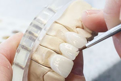 Bọc răng sứ tại nha khoa uy tín sài gòn nào? 2