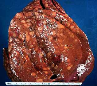 Liver cancer -cancer