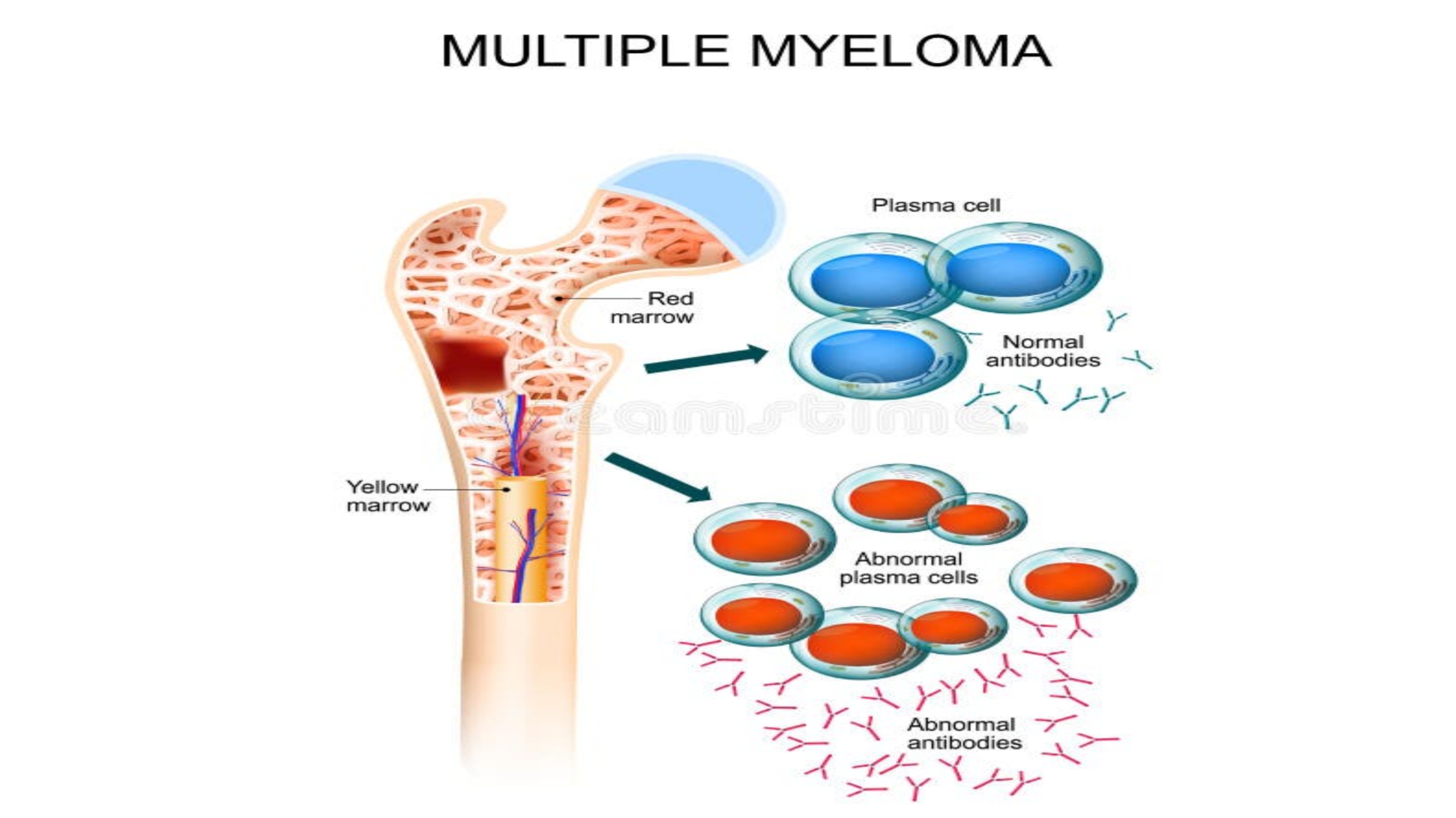 https://www.healthandfitnessexpert.in/2024/05/what-is-multiple-myeloma.html