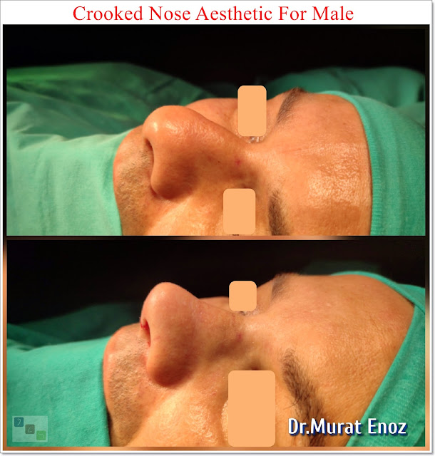Crooked Nose Aesthetic Surgery For Male,Deviated Nose Aesthetic, Asymmetric Nose Rhinoplasty