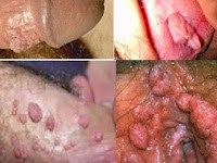 Obat Oles Kutil Kelamin Apotik