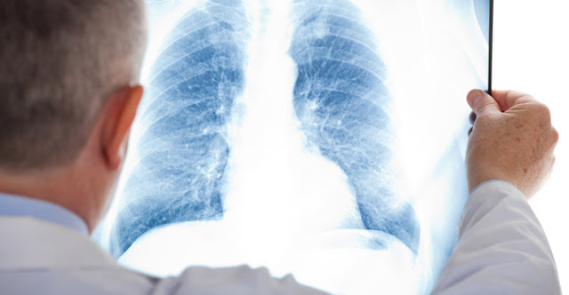 Mesothelioma Diagnosis